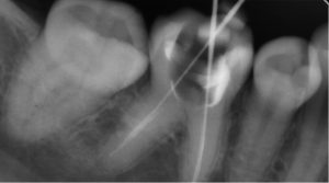 Dentalinė rentgeno nuotrauka